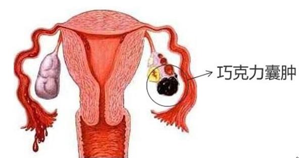 卵巢巧克力囊肿会不孕吗,卵巢囊肿导致不孕不育怎么办