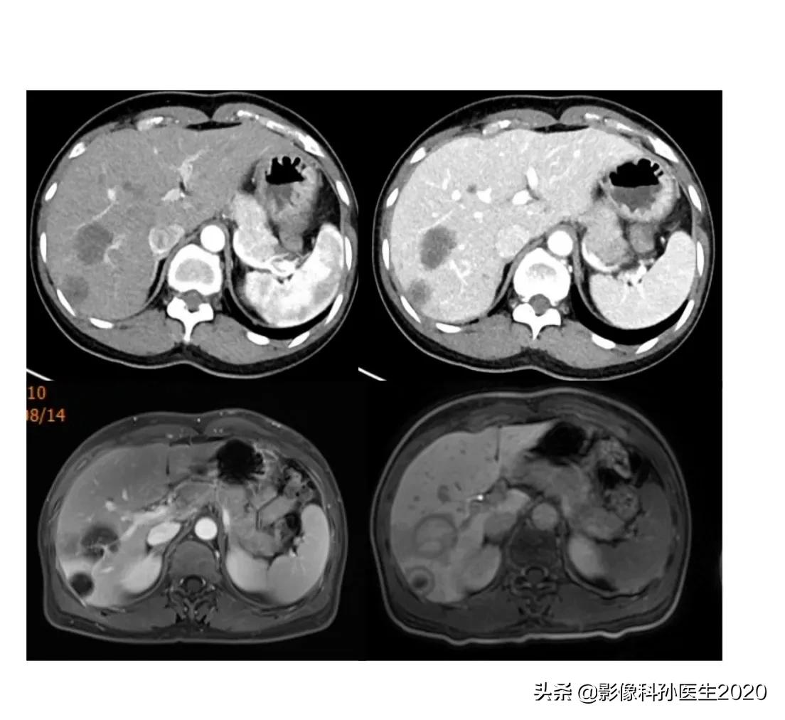 肝上皮样血管内皮瘤全国多少例,肝上皮样血管内皮瘤超声表现