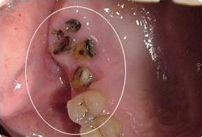 良心牙医不建议拔残根,牙医没拔干净有残根会怎样