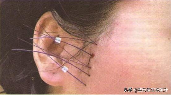 做了线雕为什么脸会肿,做了线雕为啥会越来越难看