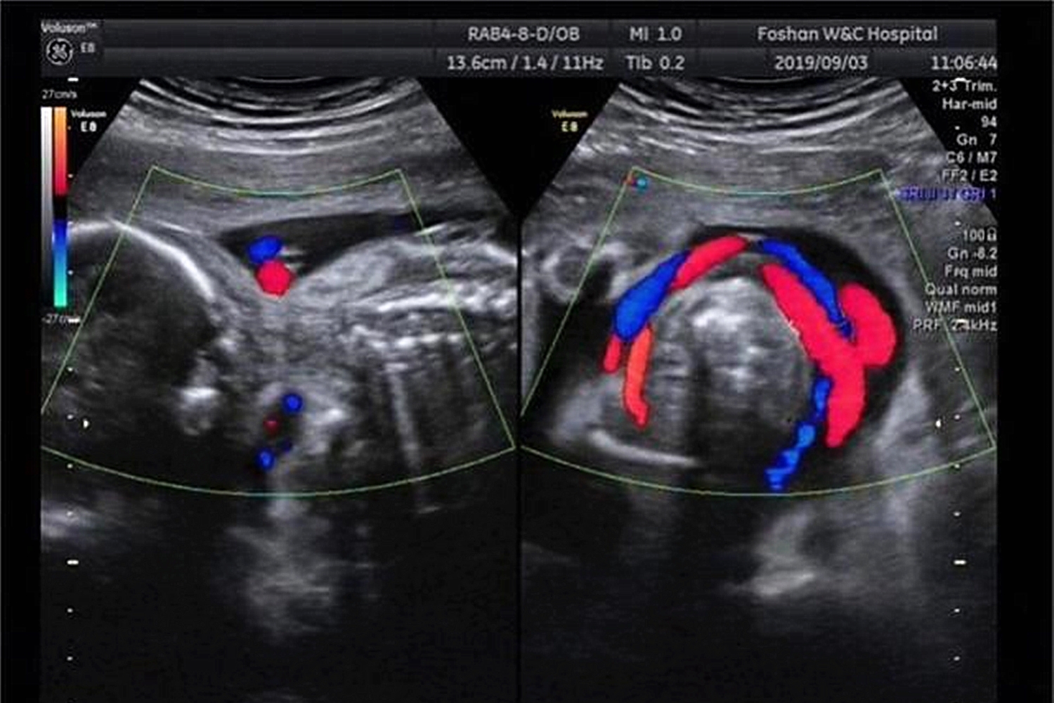 孕期第24周产检，发现胎儿脐带“打结”，孕妈起祈祷：愿宝宝平安