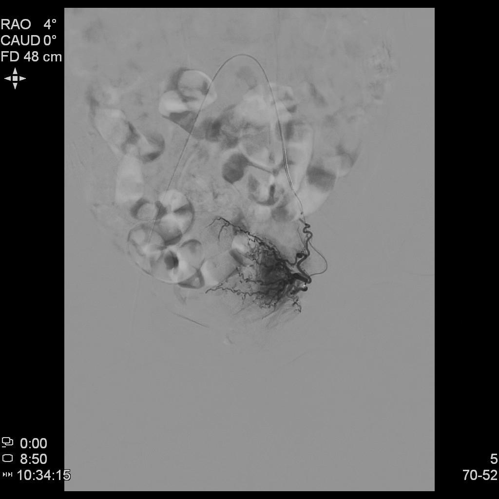 子宫腺肌症「不死的癌症」——介入栓塞来帮忙
