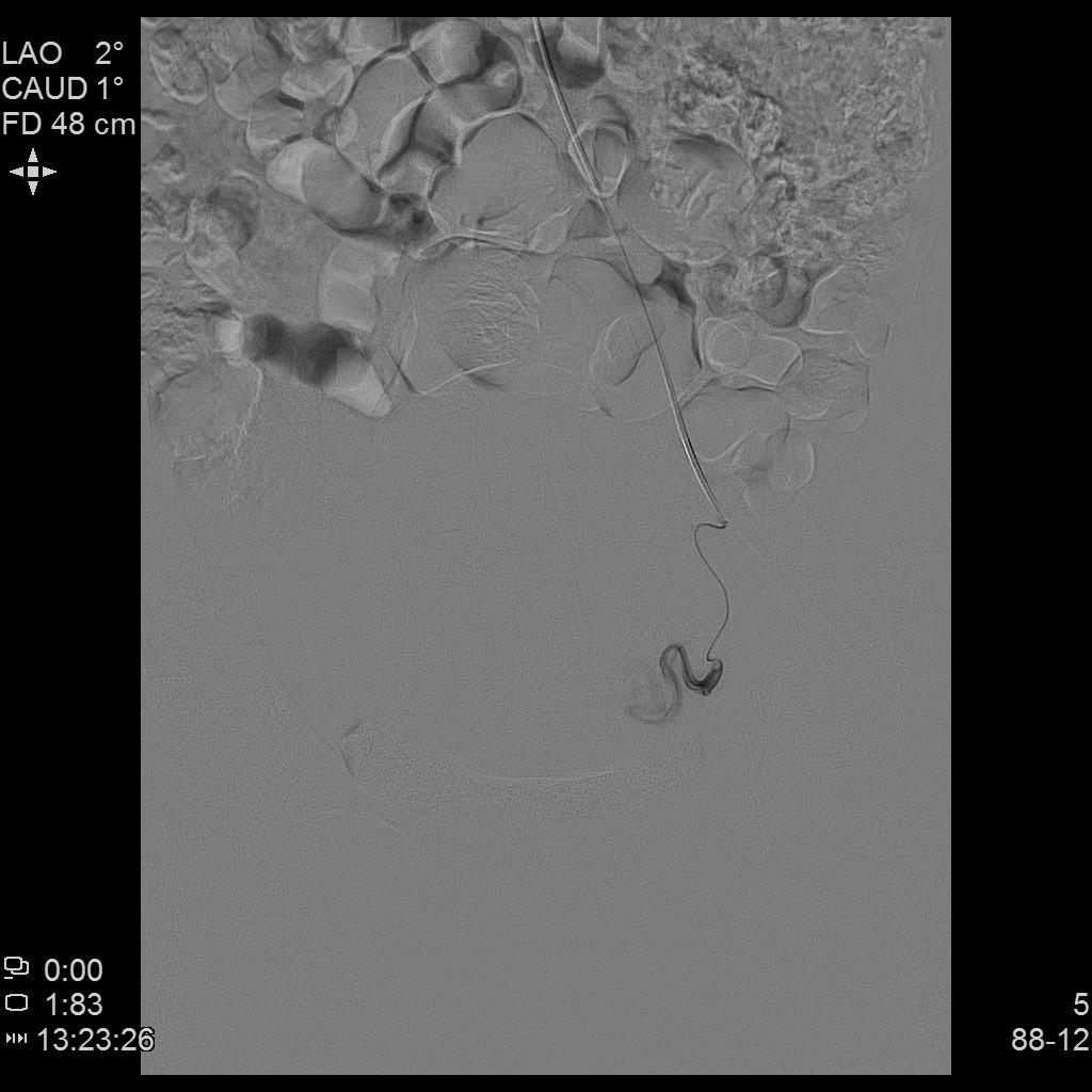 子宫腺肌症「不死的癌症」——介入栓塞来帮忙