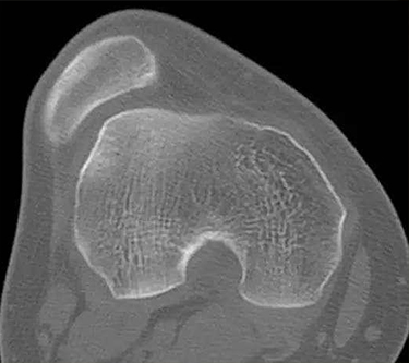 髌骨脱位复发性与习惯性区别,儿童髌骨脱位原因是什么