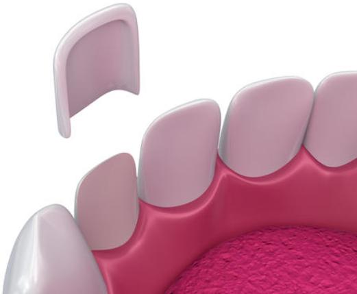 做了瓷贴面感觉牙好假,做了瓷贴面容易拆掉吗