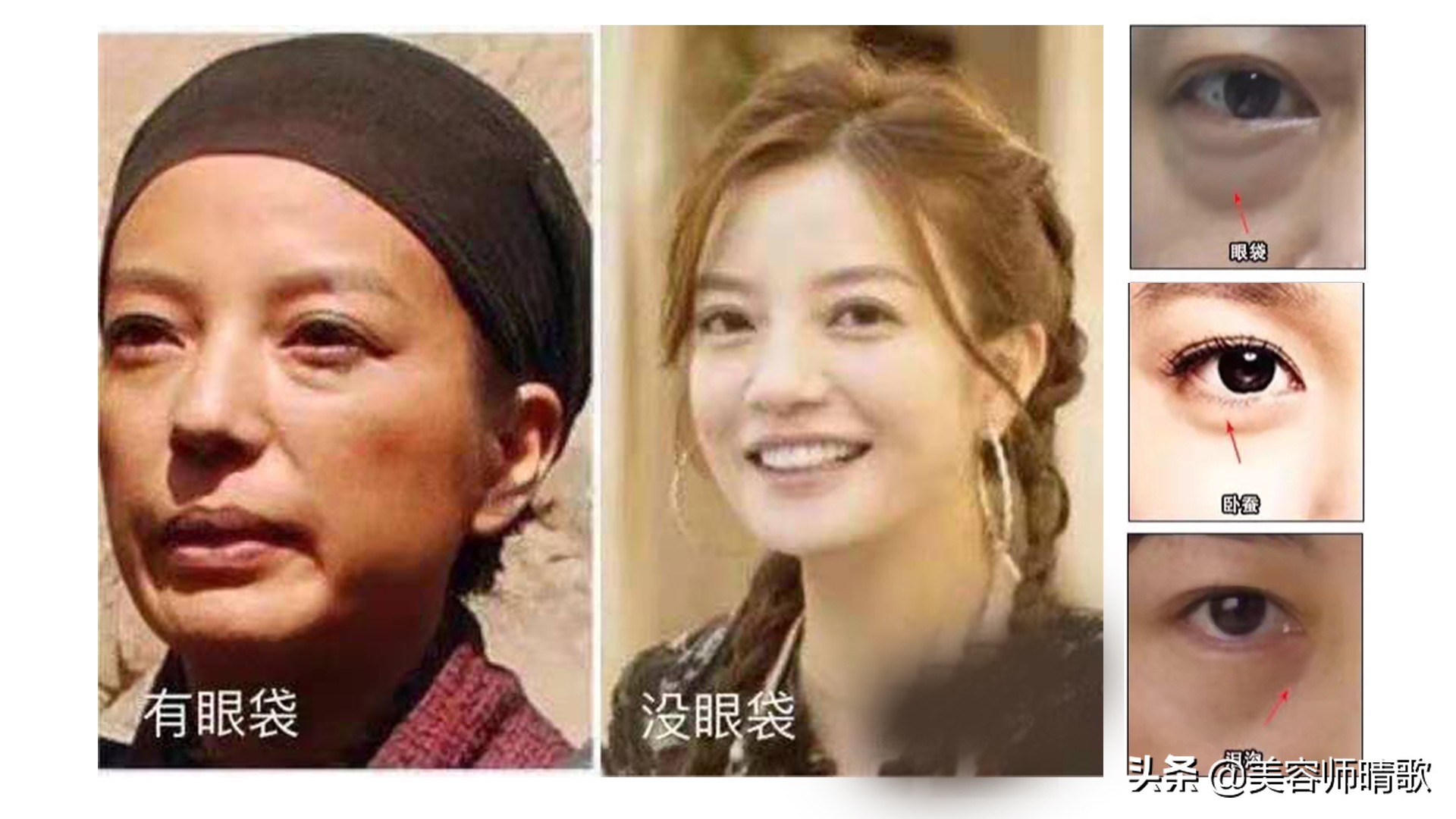 简单有效的去眼袋方法,眼袋好重秘方