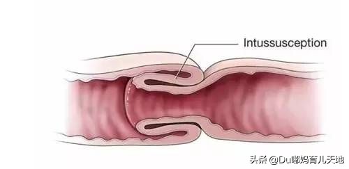 婴儿肠套叠的治疗方法有哪些,肠套叠怎么预防