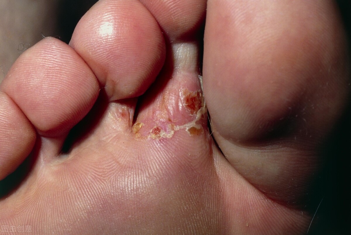 香港脚气脚癣怎么治,脚气怎么治专家现场演示