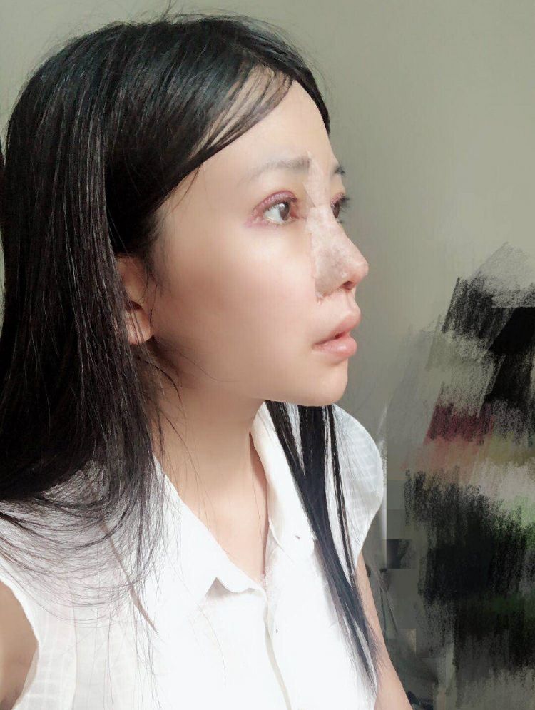 大小眼+歪鼻改善！精致感立显，仿若换头！