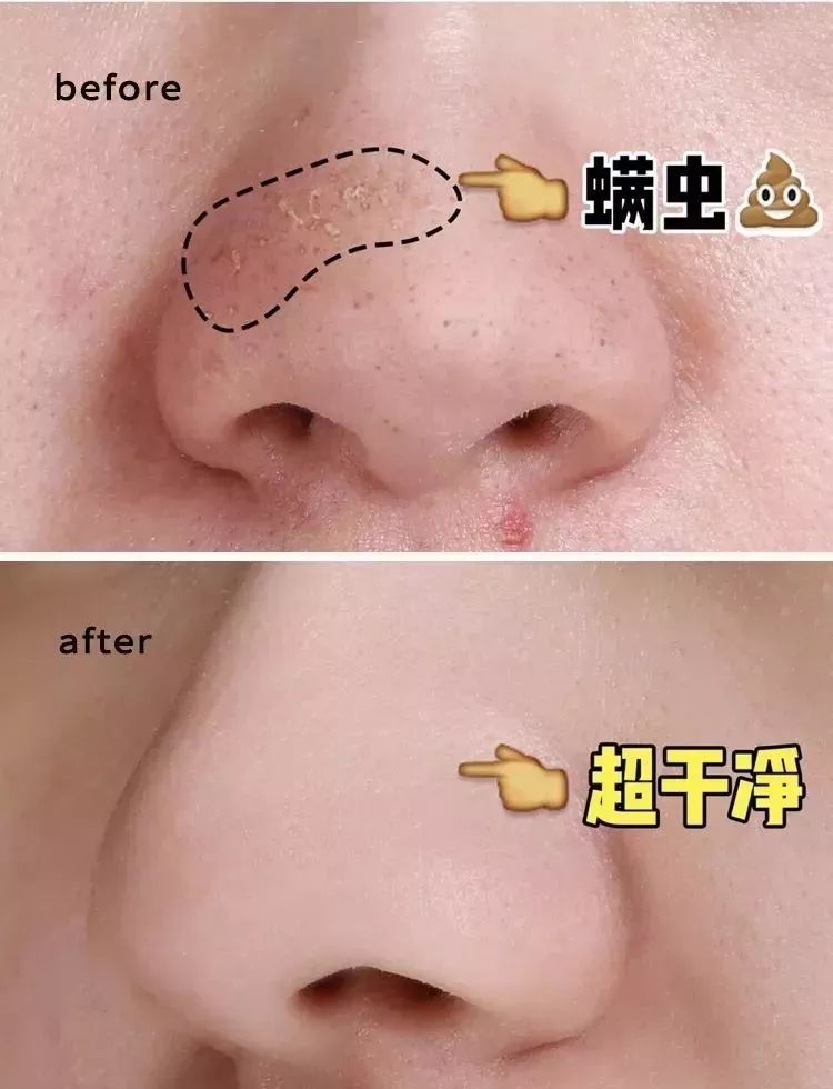 男生螨虫脸特征,螨虫脸的特征