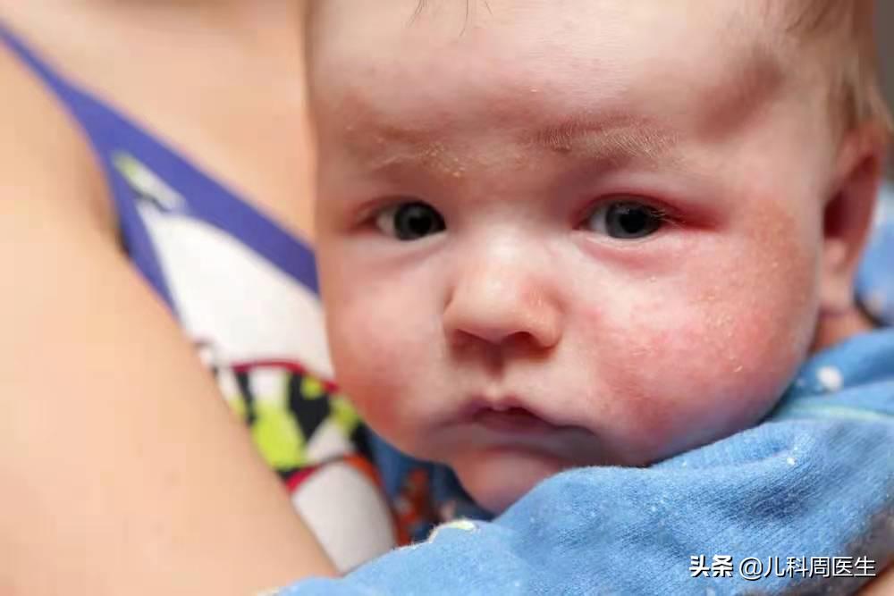 夏日长痱子、淹脖子、湿疹真假难辨？防护做得好，宝宝皮肤自然好