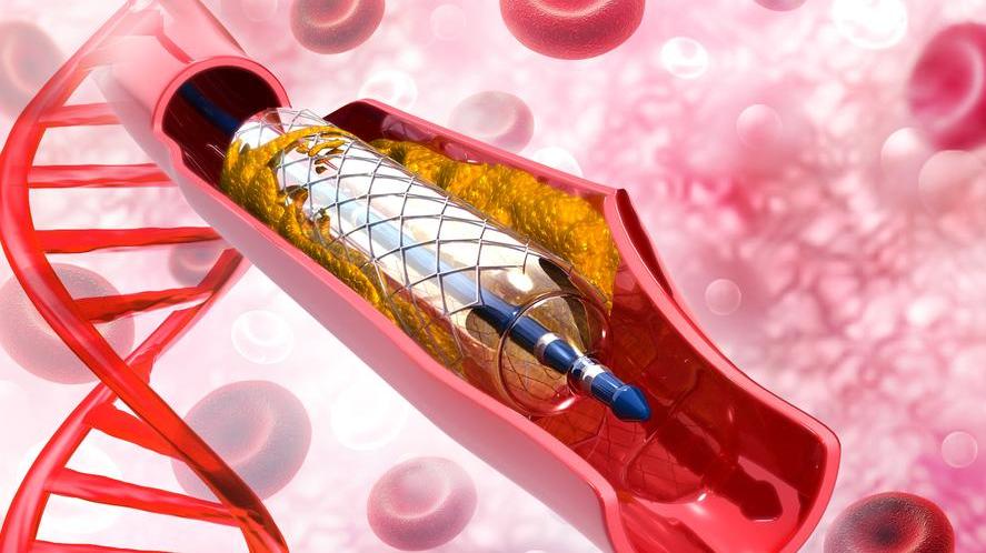 冠脉支架术后可以买什么保险,冠脉支架术后心绞痛原因