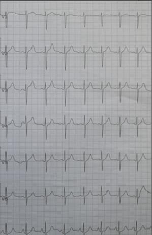 心电图诊断口诀图解,判读心电图的正确方法