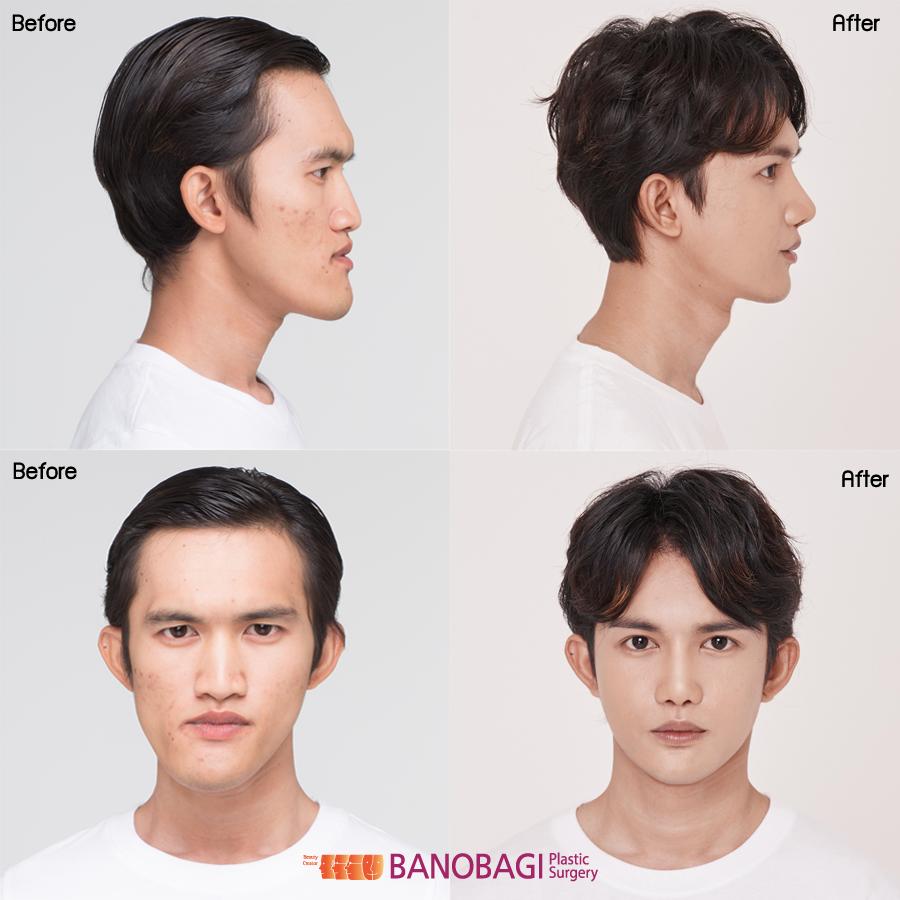 泰国最逆天的不是变性，而是堪比换头的整形