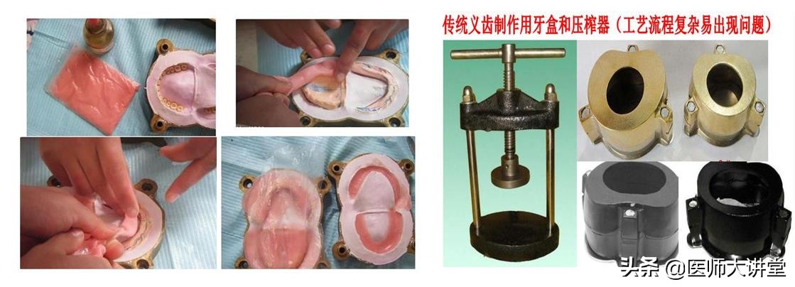 活动假牙排牙制作,下牙义齿制作