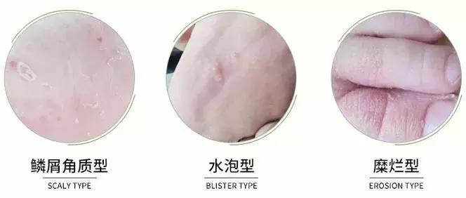 去除脚臭的日本喷雾,去脚皮臭喷雾推荐