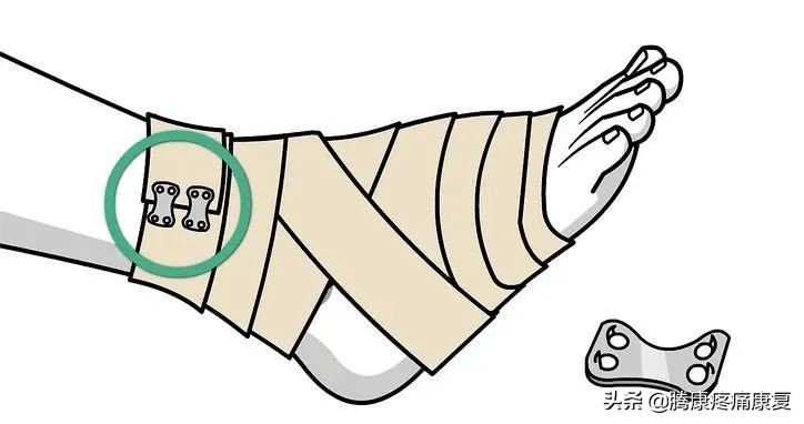 崴脚了用什么加压包扎,打篮球崴脚加压包扎