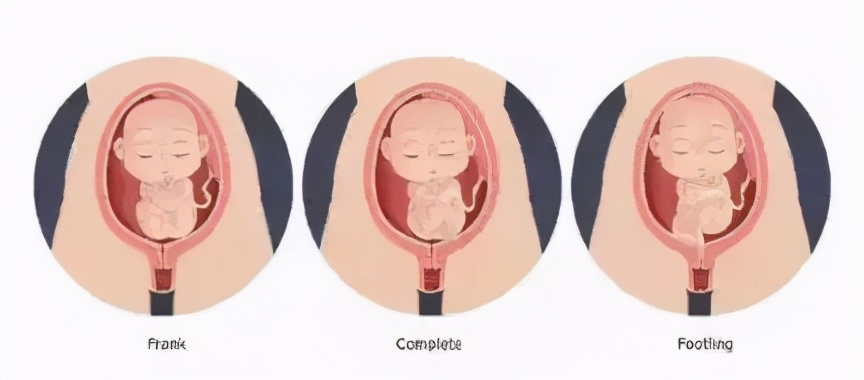 胎位不正医生徒手调胎位视频,胎儿胎位不正助产士帮忙调整胎位