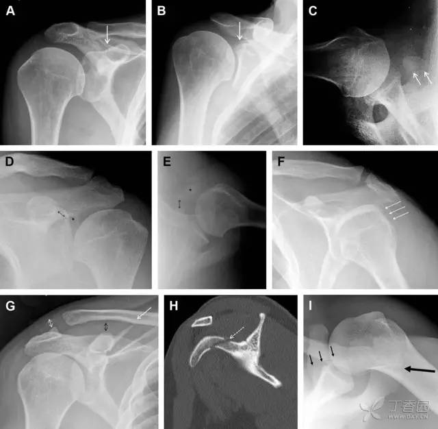 常见的八种骨折,容易漏诊的肩关节骨折