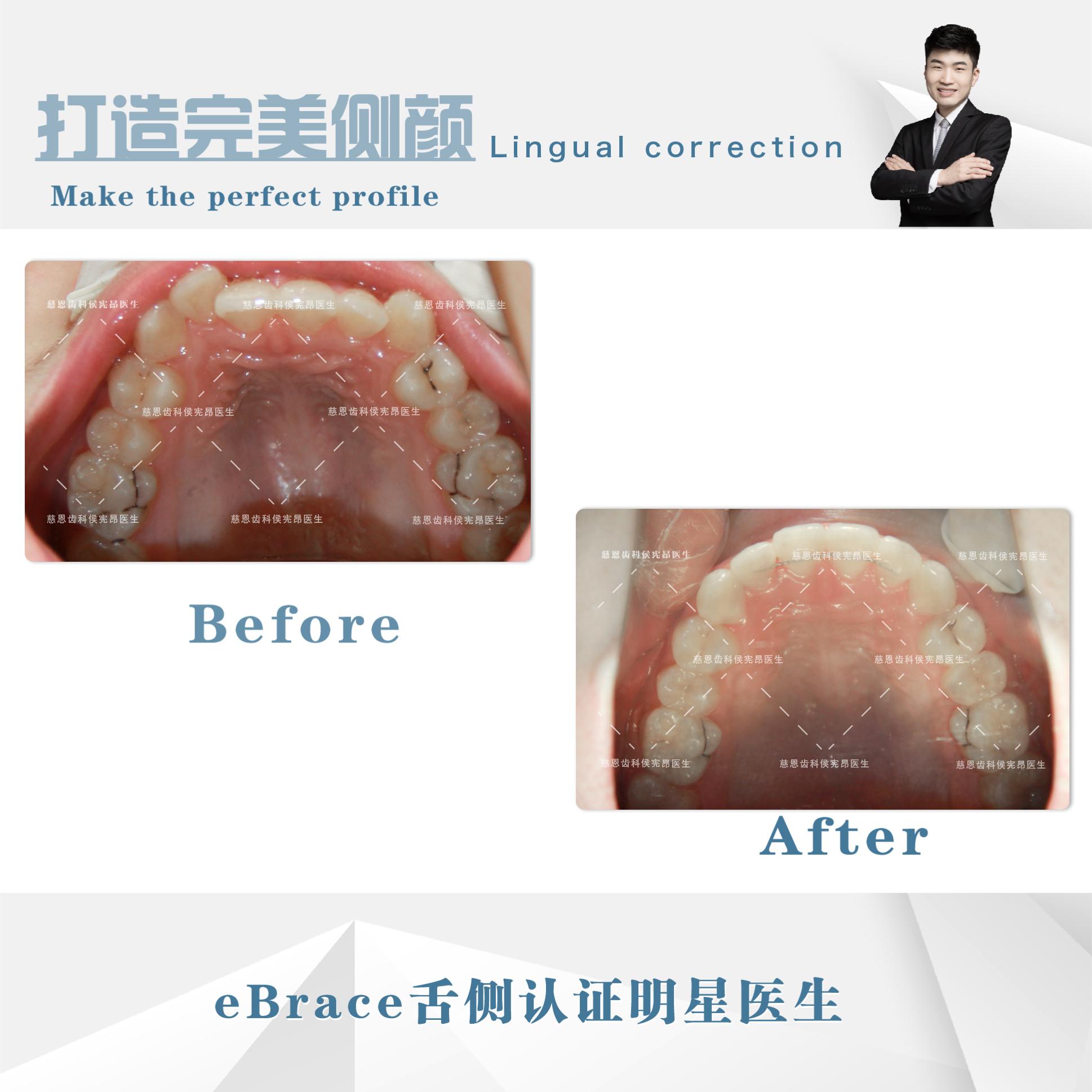 牙齿地包天矫正前后脸型对比,牙齿地包天矫正最低价多少钱