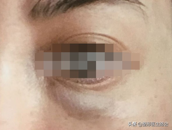 玻尿酸填泪沟为什么不吸收,玻尿酸填泪沟的好处和坏处