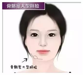 瘦脸针的5个常见问题,瘦脸针其实副作用挺大的