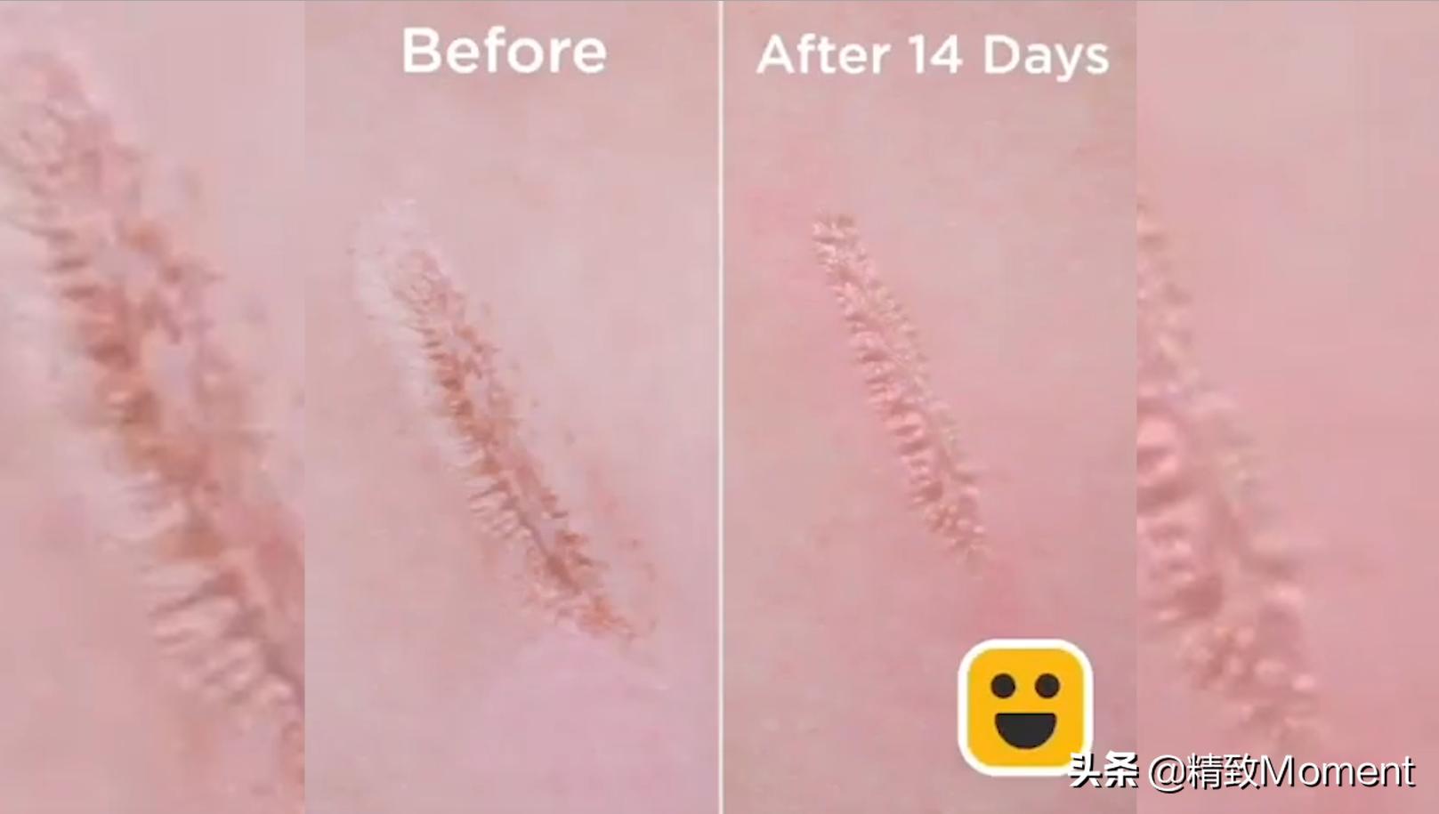 脚晒伤了发红发烫怎么快速修复,脚晒伤留下的疤怎么办