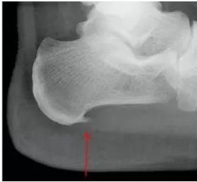 跟骨骨刺能自愈吗,跟骨骨刺封闭进针示意图