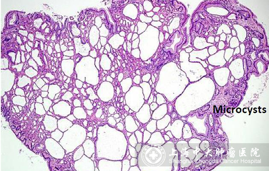 胃息肉和胃癌在胃镜下的区别,胃息肉容易变癌吗
