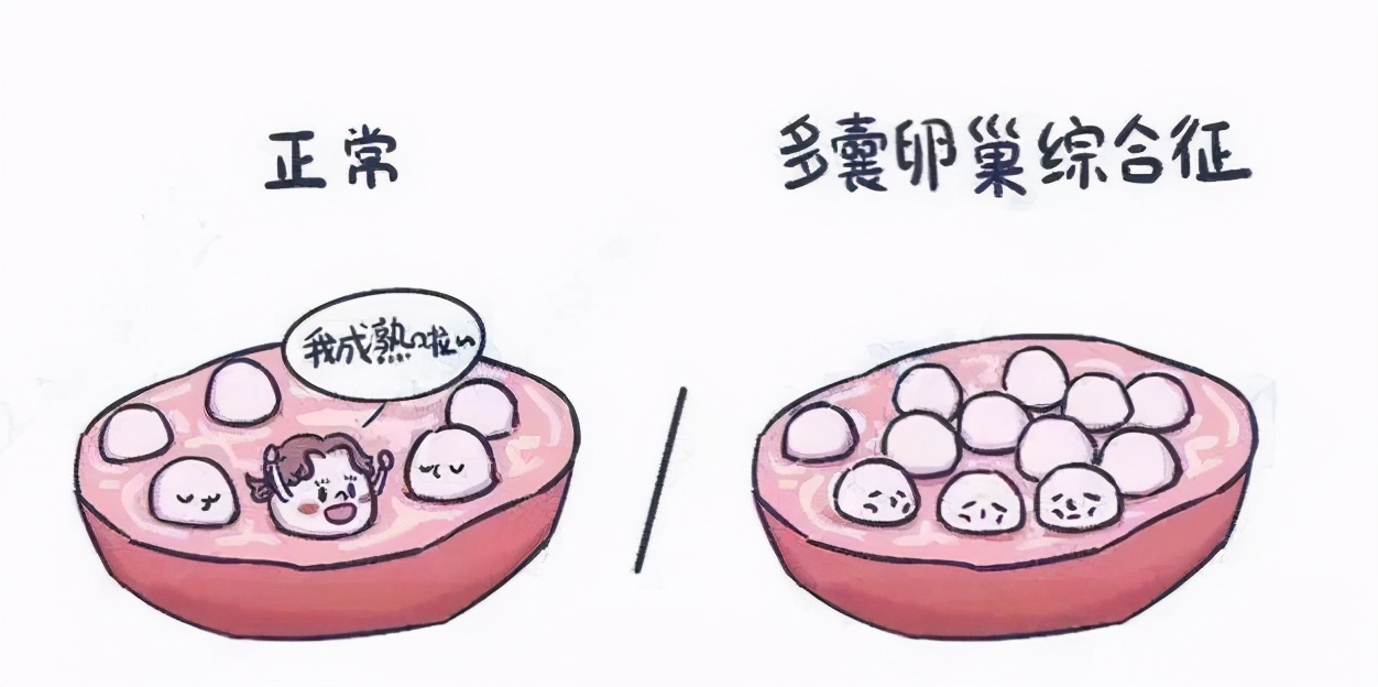 多囊卵泡长不大月经延后能怀孕么,多囊卵巢卵泡长不大中医怎么调理