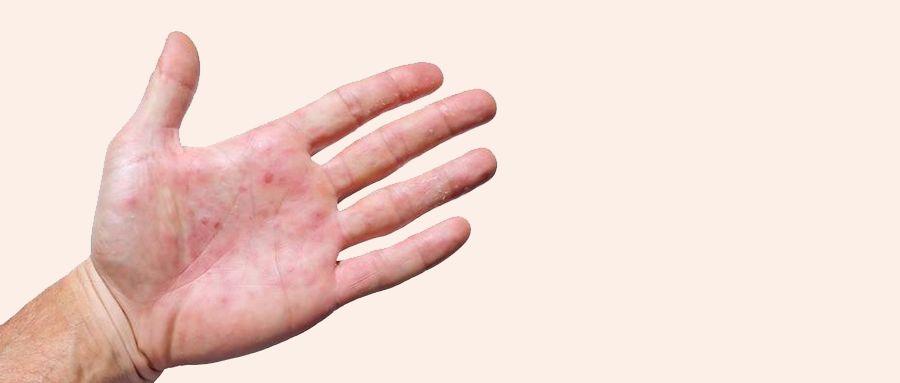 皮肤起红斑是什么病造成的,皮肤大面积红斑是什么病