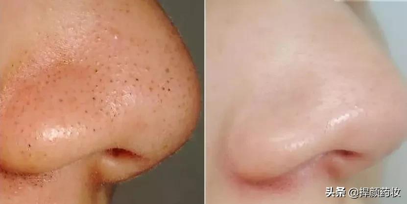 为什么黑头总是挤不完,脸上黑头粉刺用什么办法快速解决
