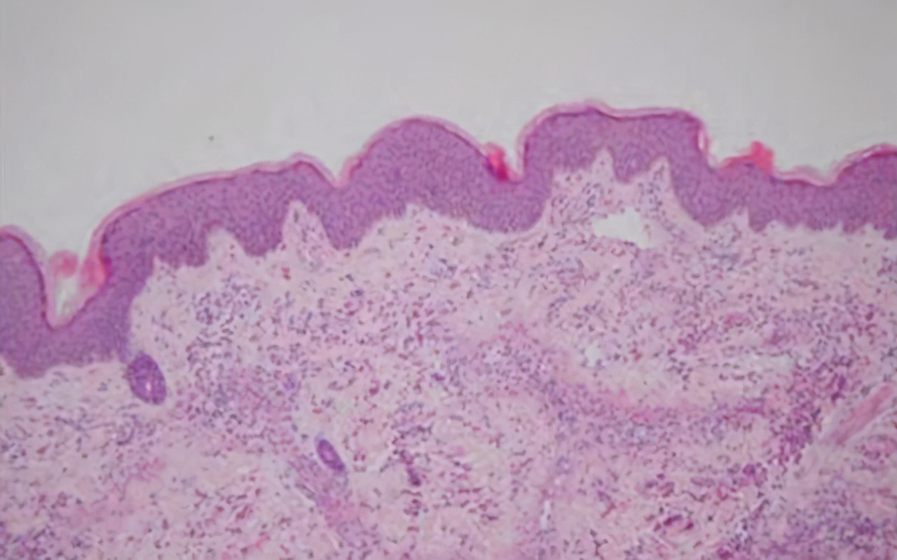 过敏性紫癜复发小红点,过敏性紫癜复发几个小红点