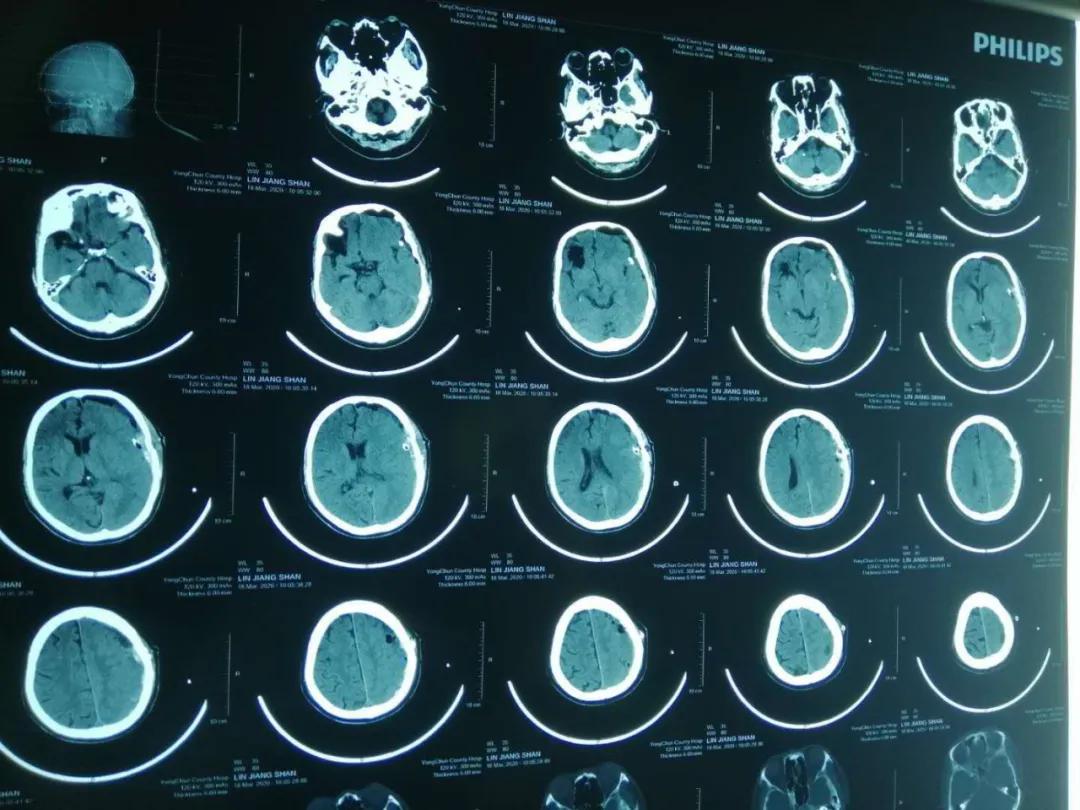 泉州：突破！永春县总医院成功开展新技术