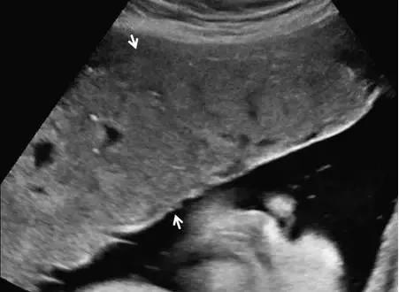 干货分享丨正常胎盘与异常胎盘的超声表现