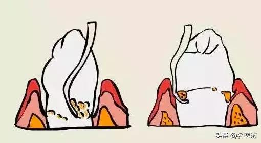 如果不小心得了牙周炎该怎么办,如果牙周炎不治疗会有什么后果