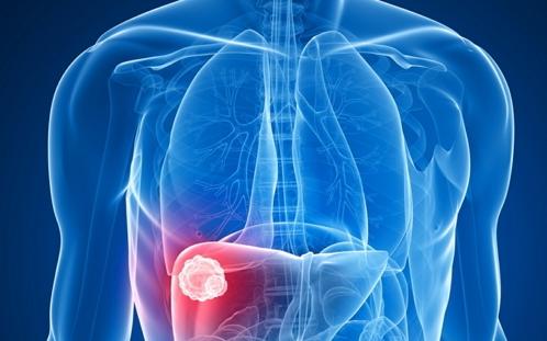 直肠癌肝转移做完介入尿是黄色的,直肠癌肝转移后肝脏复发介入治疗