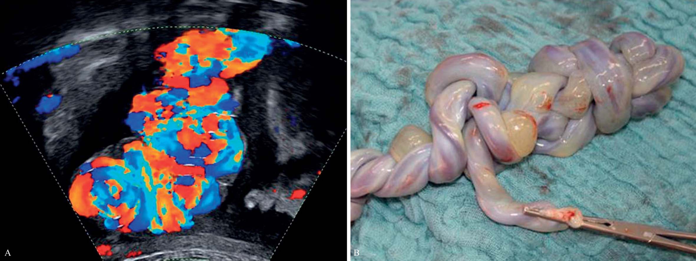 脐带过长超声诊断,脐带过长或过短能检查出来吗