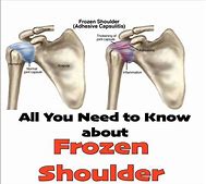 落枕，颈肩酸痛无法扭头，医生说用电吹风就能缓解？