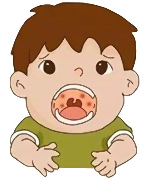 疱疹性咽峡炎有办法预防吗,疱疹性咽峡炎痊愈后要关注什么