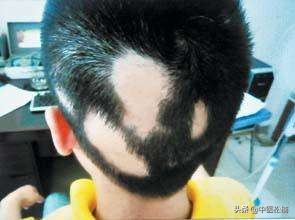 中医斑秃的主要病因是什么,斑秃中医辨证