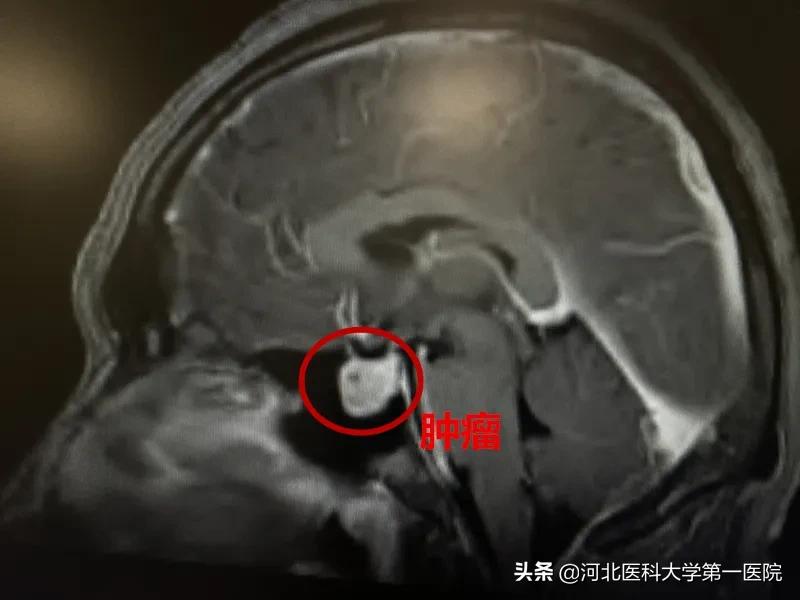 神奇魔法刀，一点就消！点亮肿瘤绝境患者，再生的希望之光