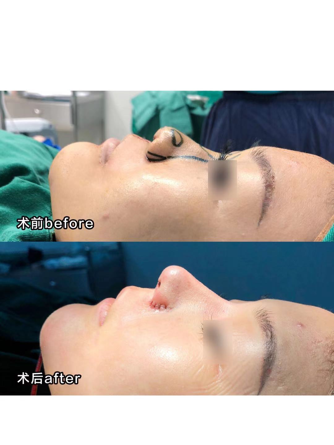 隆鼻最新视频完整版,全膨体隆鼻的视频