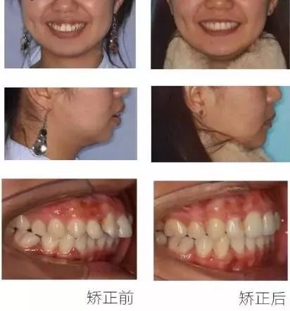 正畸主治学习视频,正畸钟摆效应名词解释