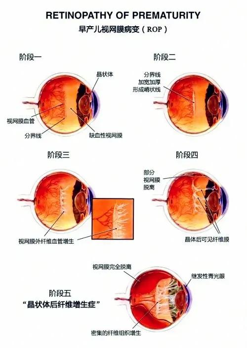 早产儿视网膜眼底筛查技巧,早产儿眼底视网膜病变筛查流程