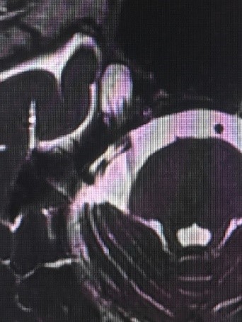 三叉神经痛需要抗癫痫治疗吗,癫痫引起的三叉神经痛怎么治疗