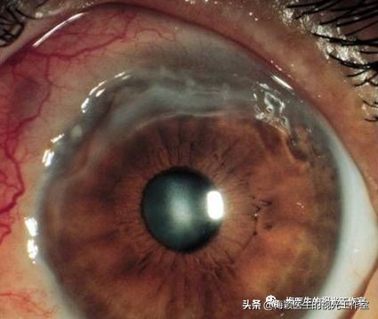 补充维生素a对干眼有效吗,补充维生素a视力会恢复吗