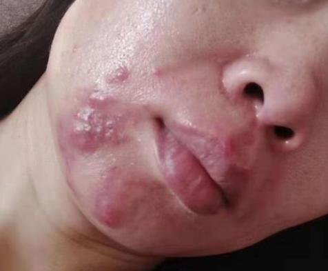 痘痘是如何形成的,痘痘是怎么形成的