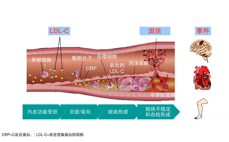 动脉粥样硬化斑块吃哪种他汀最好,他汀类药物针对动脉斑块有作用吗
