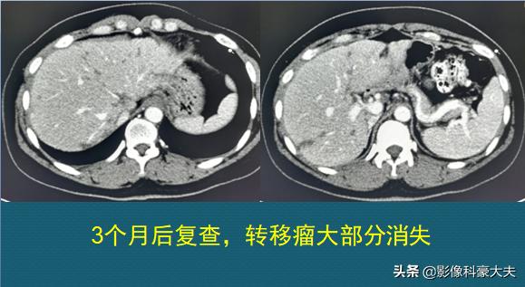 22岁查出癌症放弃治疗,医生自述得癌症放弃治疗